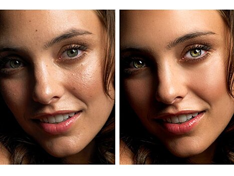 Учёные рассказали, как избавиться от пятен и рубцов после прыщей