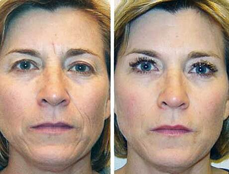 Стираем «межбровку» без уколов самостоятельно