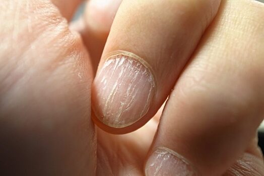 Рак можно диагностировать по ногтям