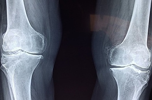 СМИ: причиной остеоартрита может быть крошечная кость в колене