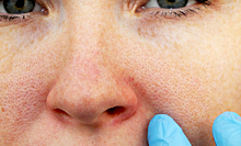 Пять болезней, при которых сильно чешется нос
