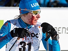 Российской лыжнице Медведевой, получившей рассечение во время гонки на ЧМ, наложили швы