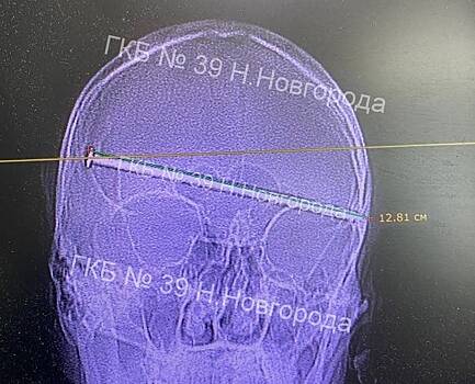 Огромный гвоздь насквозь проткнул головной мозг россиянина