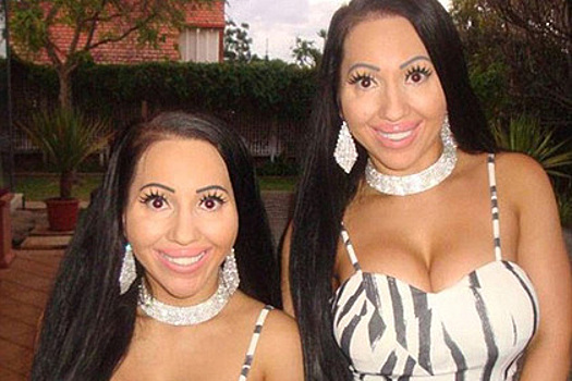 Потратившие $250 тысяч на пластику близнецы пожалели о своем сходстве