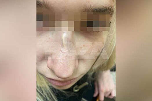 В Москве девушка сделала проблемную ринопластику и потребовала 14,5 млн
