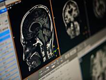 Ученые нашли причину ухудшения работы мозга у миллионов людей