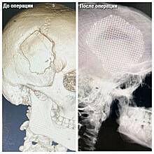 Подмосковные врачи успешно вживили титановую 3D-пластину пациенту с нарушением кровообращения мозга