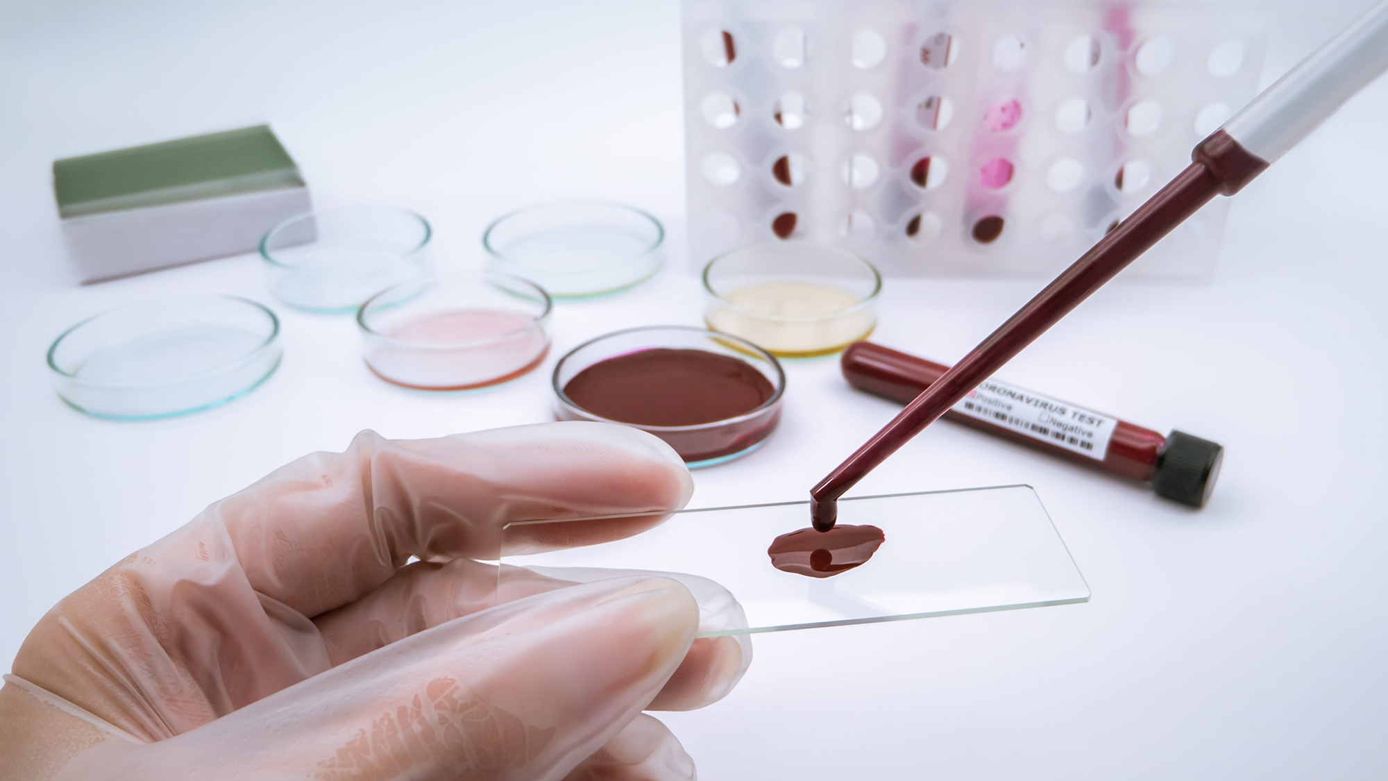 Анализы крови, которые спасут жизни: 3 примера