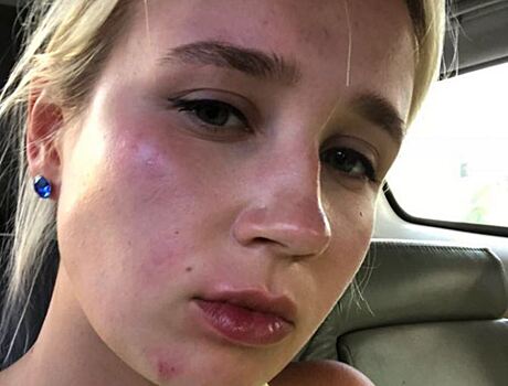 Ведущая «Орла и решки» травмировалась на съемках в Таиланде