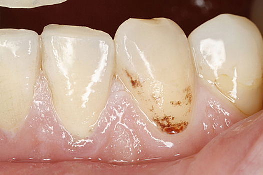 Женщина устала ждать стоматолога и руками вырвала себе 13 зубов