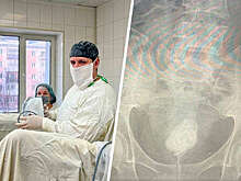 В Кемерове врачи спасли мужчину с 6-сантиметровым камнем в мочевом пузыре