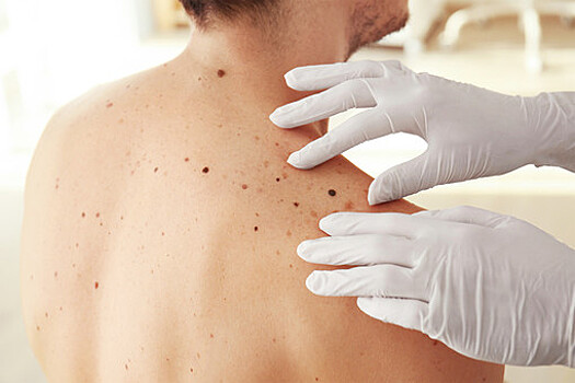 Врач Пылев: склонность к получению солнечных ожогов связана с риском рака кожи