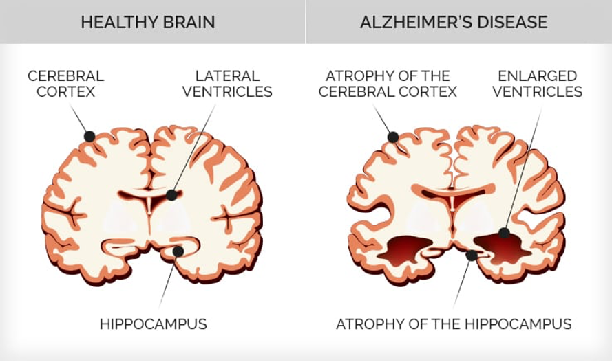 Вести с полей: оптогенетическая стимуляция астроцитов против болезни Альцгеймера