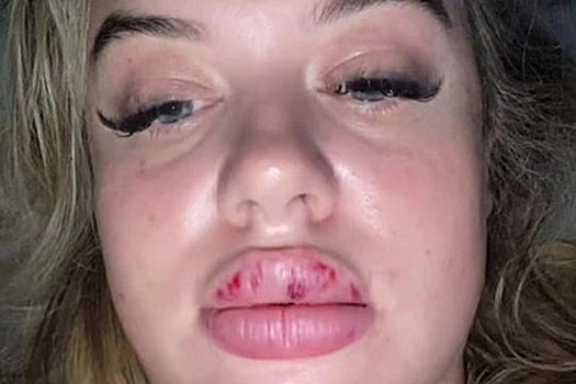 Девушка выпила вино после увеличения губ врача и пожалела