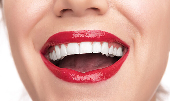 Что такое виниры и зачем они нужны