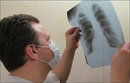 В Краснокаменском районе в 2 раза чаще стали болеть туберкулёзом