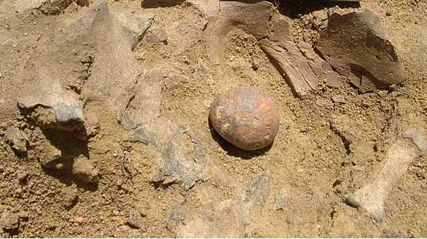 Древнейшие камни в простате обнаружили у мужчины каменного века