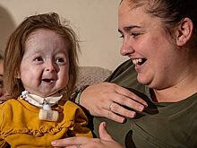 «Болезнь Бенджамина Баттона»: как живет девочка с самым редким генетическим отклонением