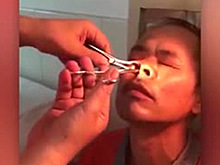 Большая пиявка две недели жила у китайца в носу