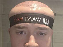 Mirror: британец стал похож на Мегамозга после пересадки волос