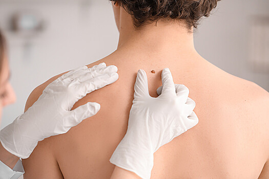 Эксперт объяснил, как легко распознать опасную родинку