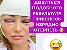 Опухшая Дана Борисова показала поклонникам лицо после пластической операции