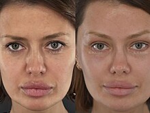 Виктория Боня недовольна пластикой лица и снова летит в США на операцию