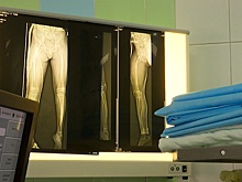 Титановая опора для костей: как в Кургане помогают «хрустальным детям»