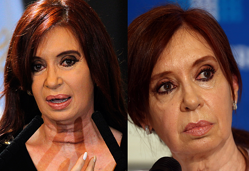 Экс-лидер Аргентины Кристина Фернандес де Киршнер (до и после операции)