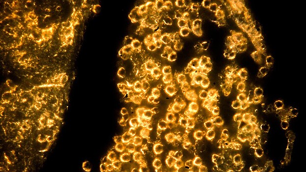 Найдено решение одной из ключевых проблем в лечении рака