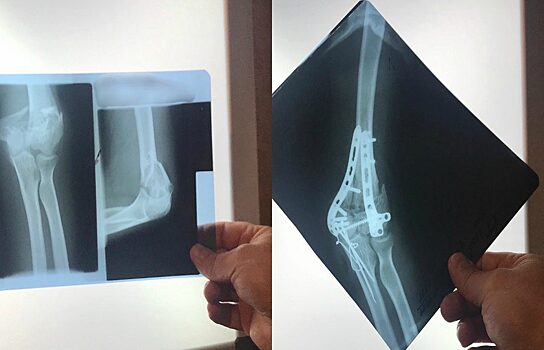 В Челябинске врачи заново собрали руку беременной женщине