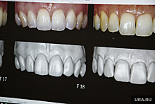 Стоматолог раскрыл, как спасти выбитый зуб