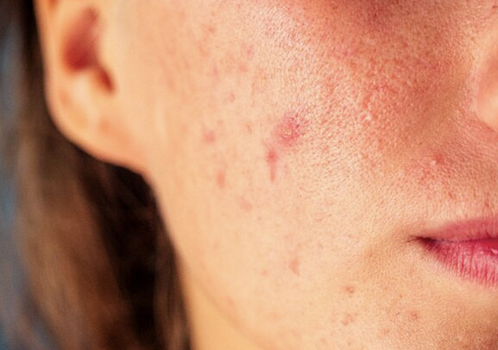 Дерматолог объяснила, как проявляется аллергия на солнце