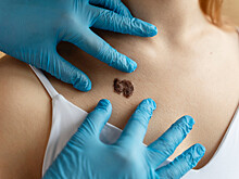 Врачи перечислили ранние признаки рака кожи