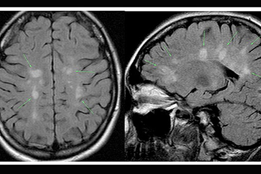 Рассеянный склероз: Европа под ударом