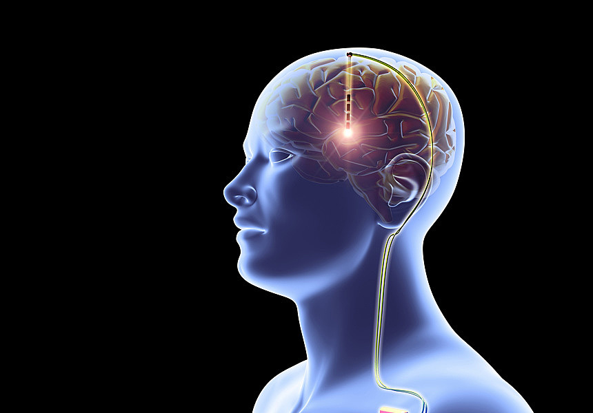 Зависимость от наркотиков решили лечить вживлением имплантата в мозг