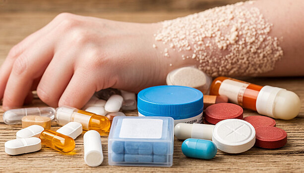 Правозащитник Посадкова: Без инвалидности люди с псориазом не могут получить медикаменты