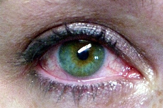 Что делать при синдроме «сухого глаза»?
