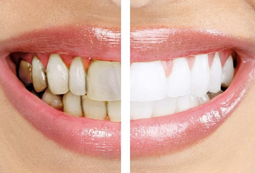 5 причин возникновения зубного камня и способы профилактики