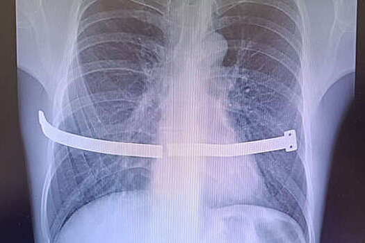 В Сургуте врачи спасли мужчину с разломившейся пластиной в грудной клетке