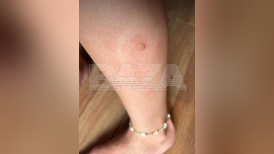 Россиянку госпитализировали на Бали после укуса насекомого