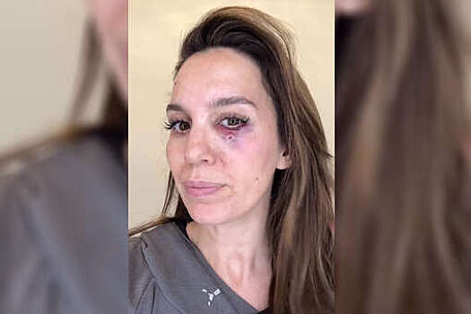 Актриса Кристи Карлсон Романо рассказала, что отлично восстанавливается после выстрела в лицо