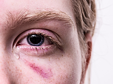 Нижегородец начал терять зрение после драки с водителем