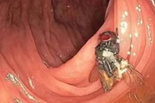 Врачи нашли в кишечнике мужчины живую жужжащую муху