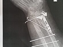 Врачи в Красногорске спасли женщину с множественными переломами руки