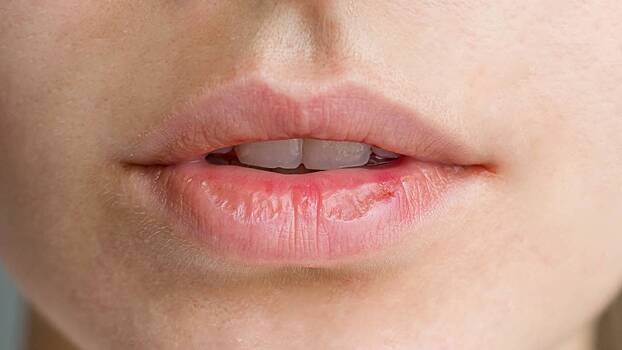 Эксперты рассказали, как справиться с проблемой обветренных губ