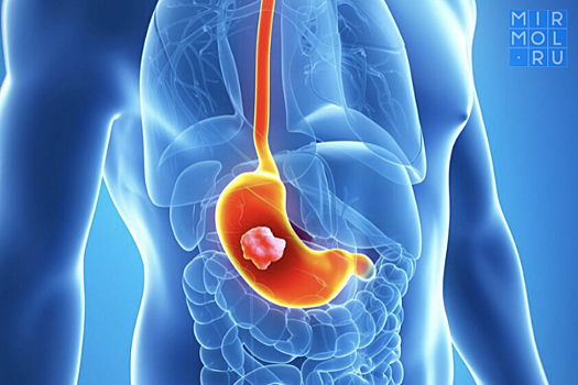 Названы симптомы, указывающие на рак желудка