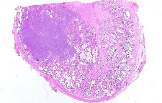 Агрессивную форму рака простаты объяснили ученые