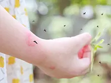 Эксперты рассказали, когда укус насекомого становится опасным для ребенка