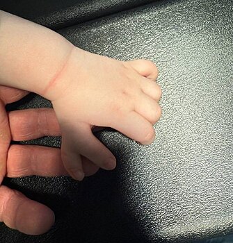 В Удмуртии врачи удалили лишние пальцы на обеих руках годовалого малыша